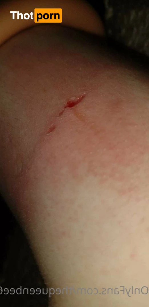 TheQu33nOfAmputations 4859305